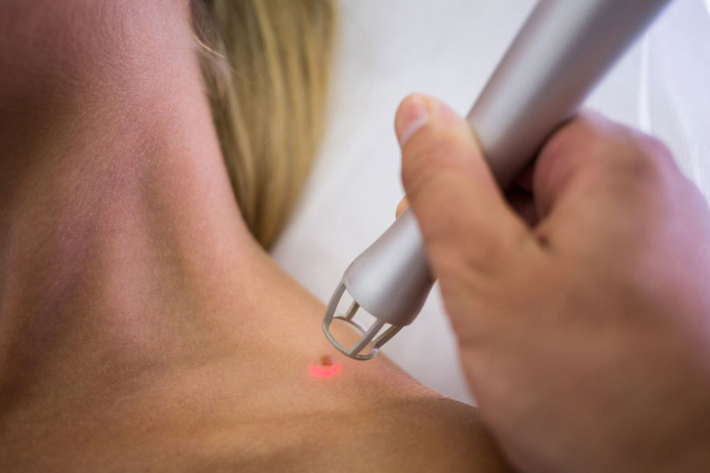 Mole Removal In Wilmington Lavish Wellness Aesthetics