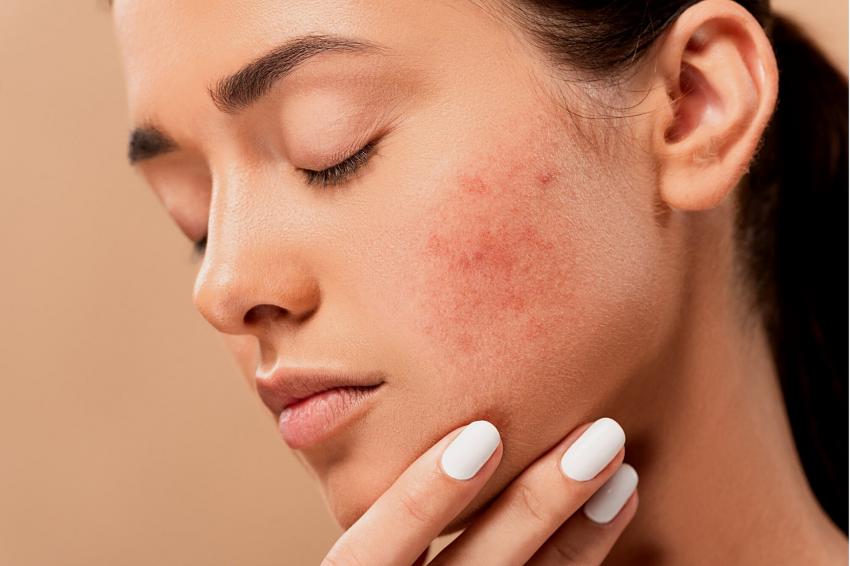 Rosacea in wilmington