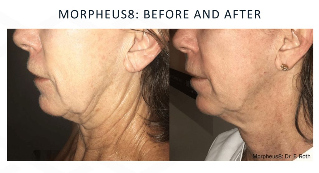 Morpheus 8 treatment Wilmington at Lavish Wellness & Aesthetics
