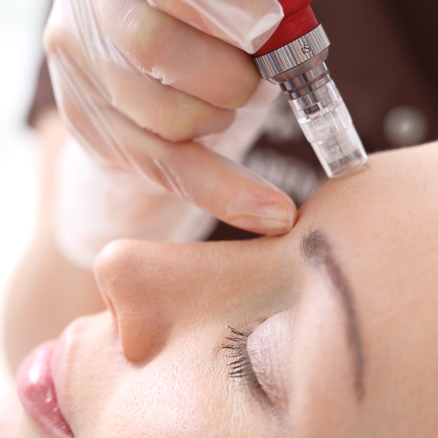 benefits of microneedling