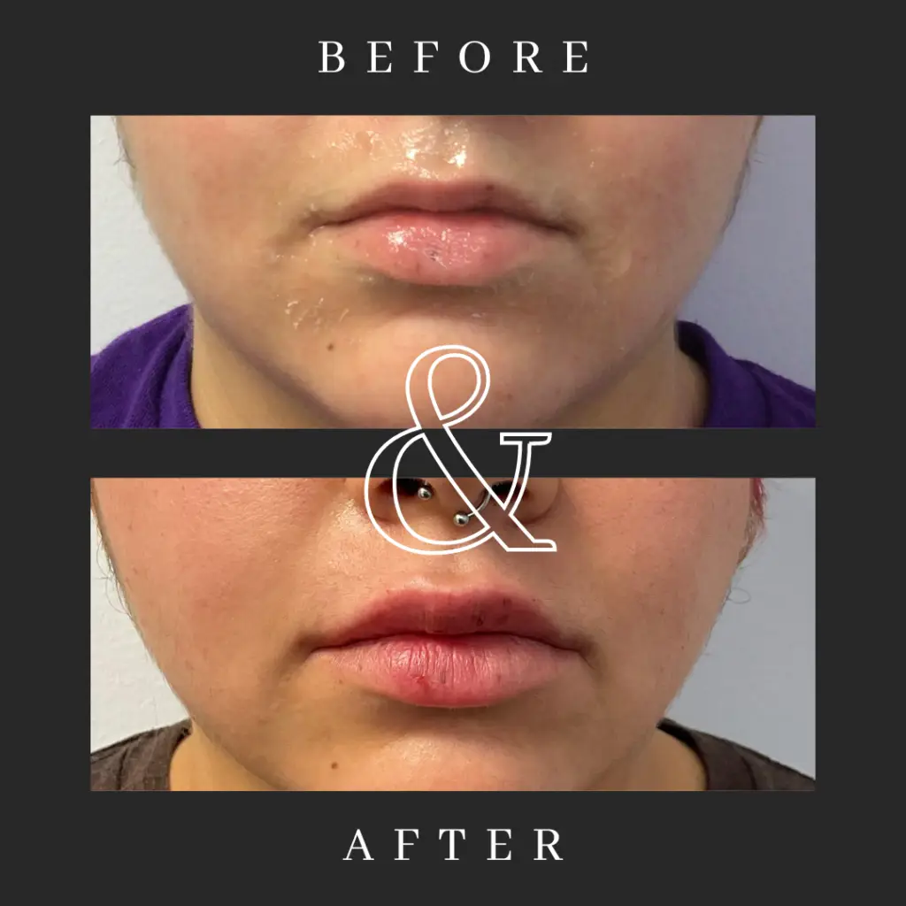 Before and after of lip filler at Lavish Wellness & Aesthetics