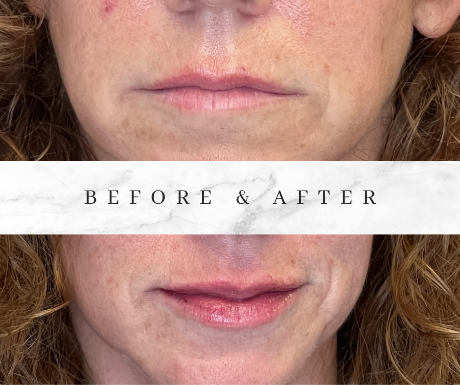 Before and after of lip filler at Lavish Wellness & Aesthetics