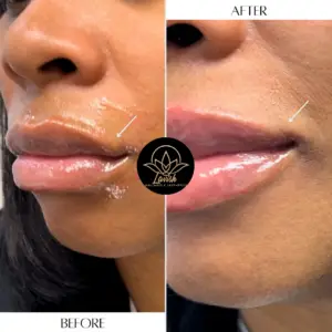 Dermal Filler Wilmington