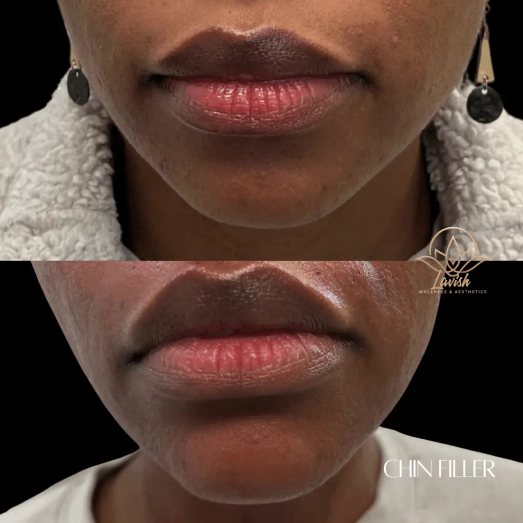 Chin Filler Lavish