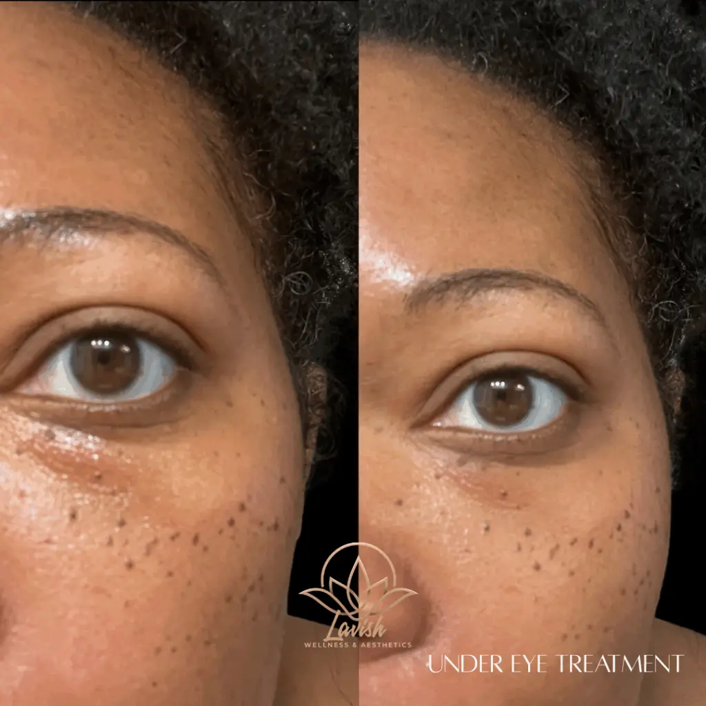 Undereye Treatment Wilmington