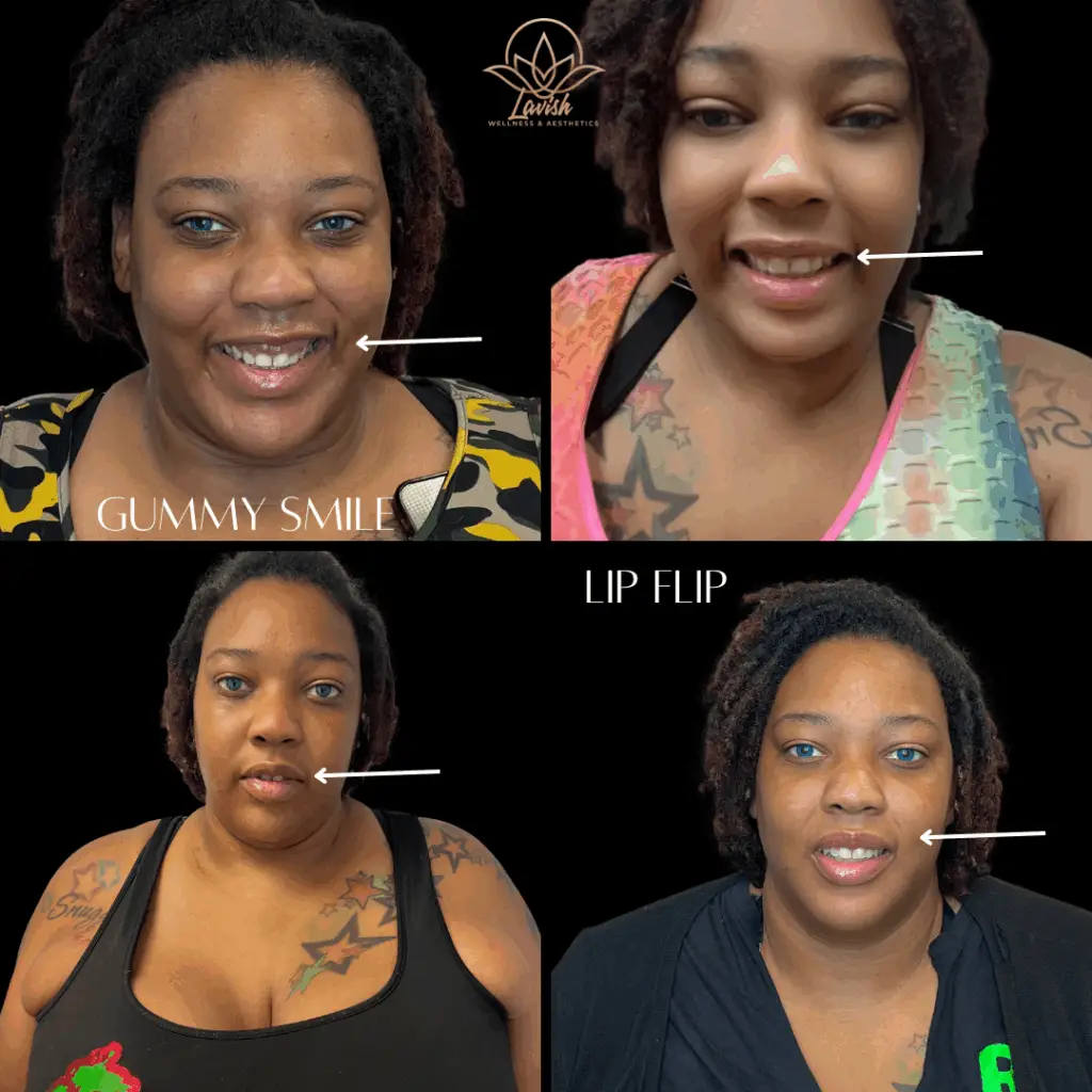 Before and After Lip Flip Gummy Smile
