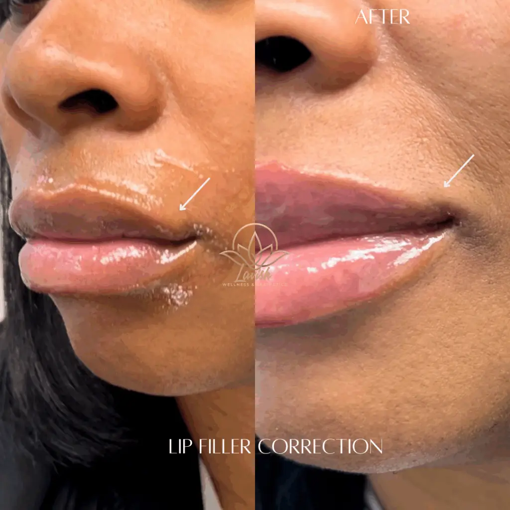 Lavish Lip Filler Correction