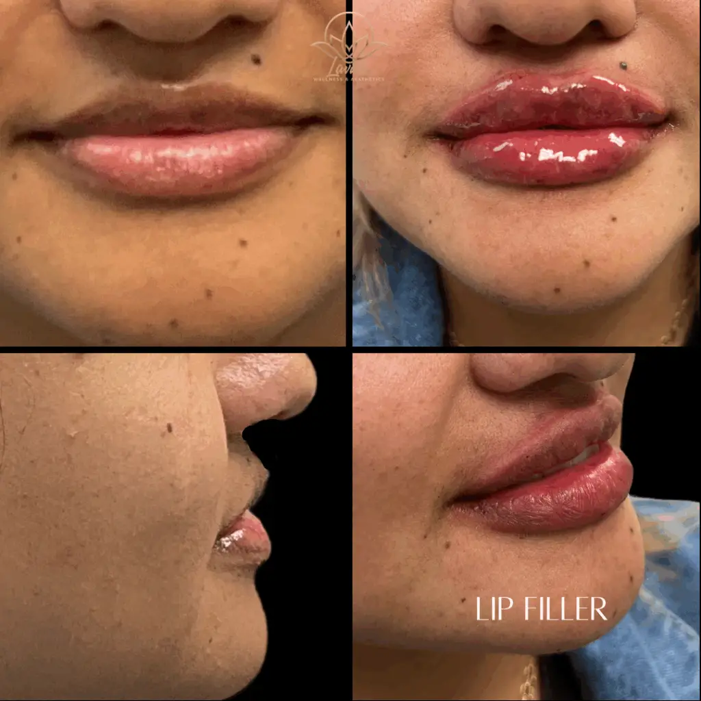 Lip Filler Lavish 2 (1)