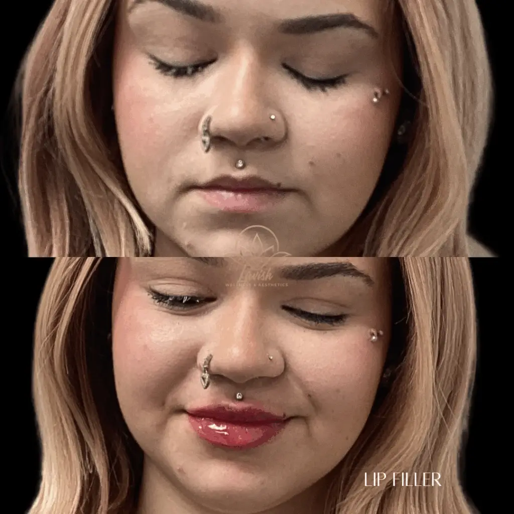 Lip Filler Lavish (2)