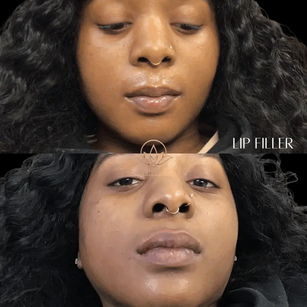 Lip Filler Lavish 5 (1)