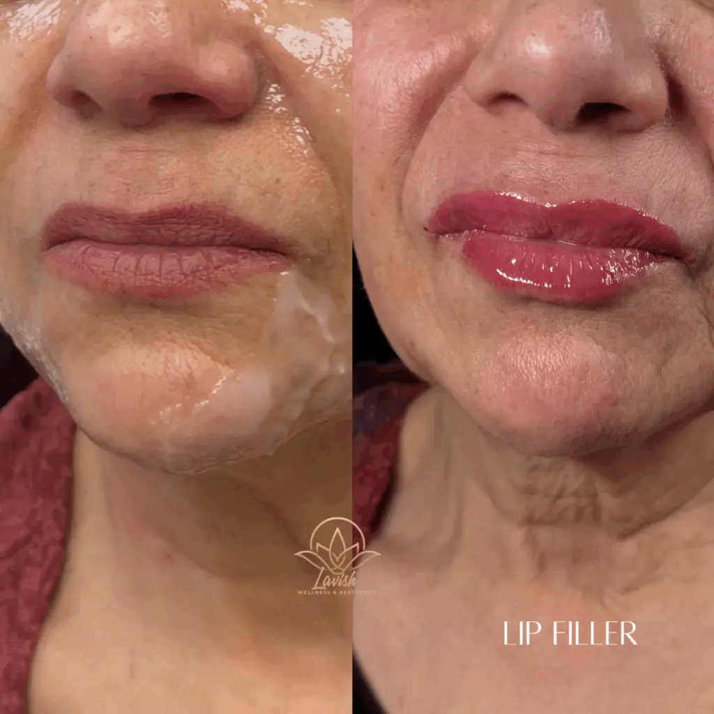 Lip Filler Lavish 6 (1)