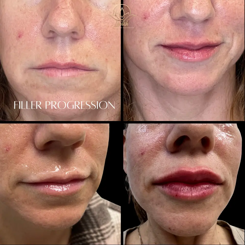 Lip Filler Progression (1)