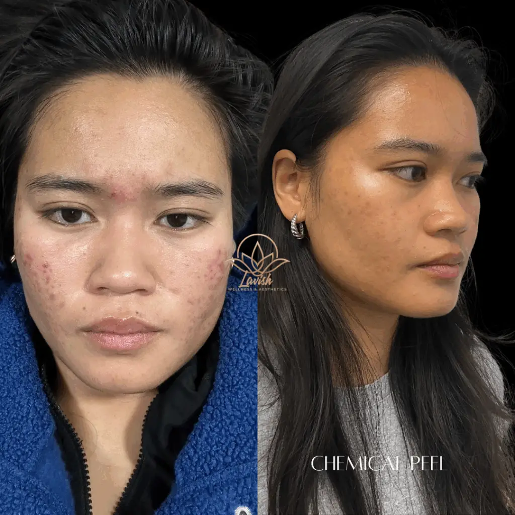 VI Peel Before and After (1)