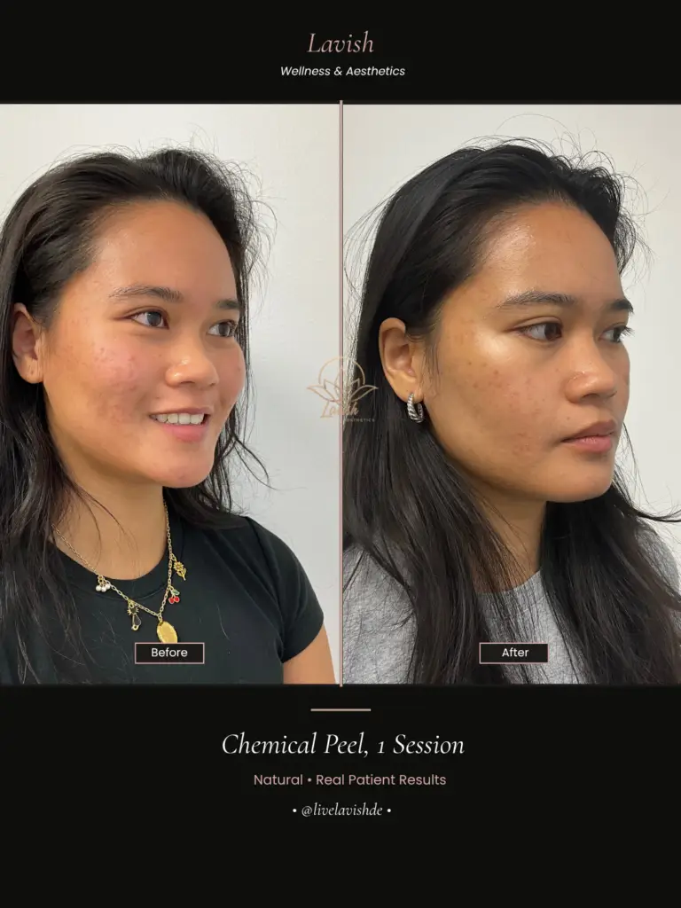Chemical Peel In Wilmington DE
