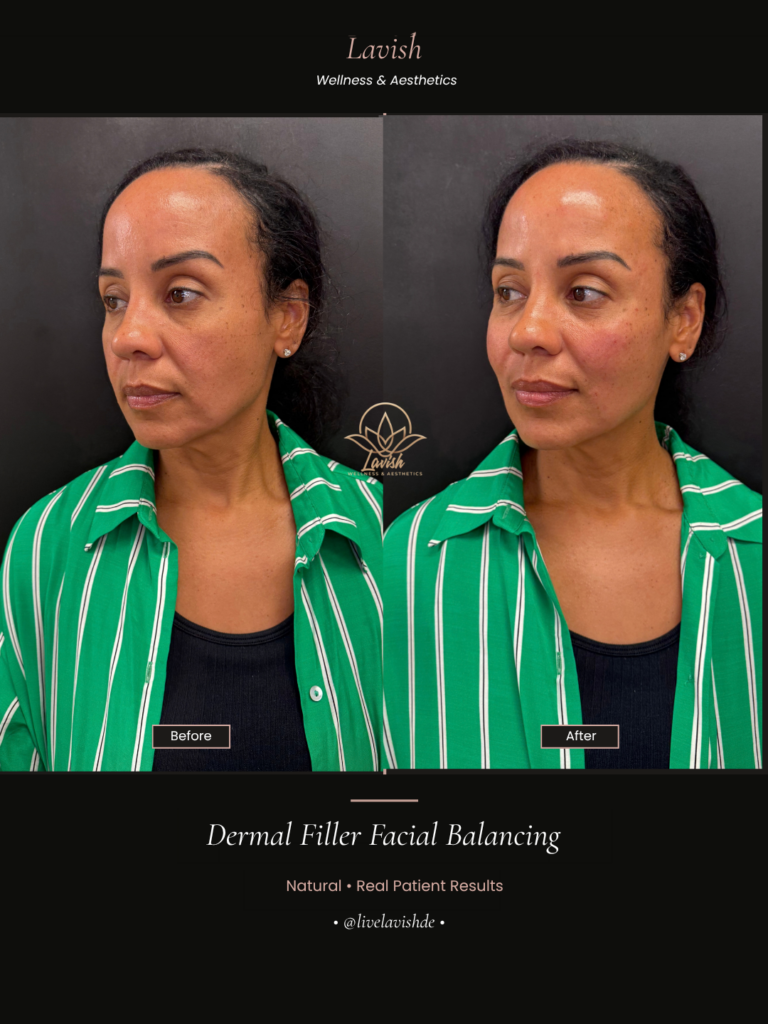 Dermal Filler In Wilmington DE