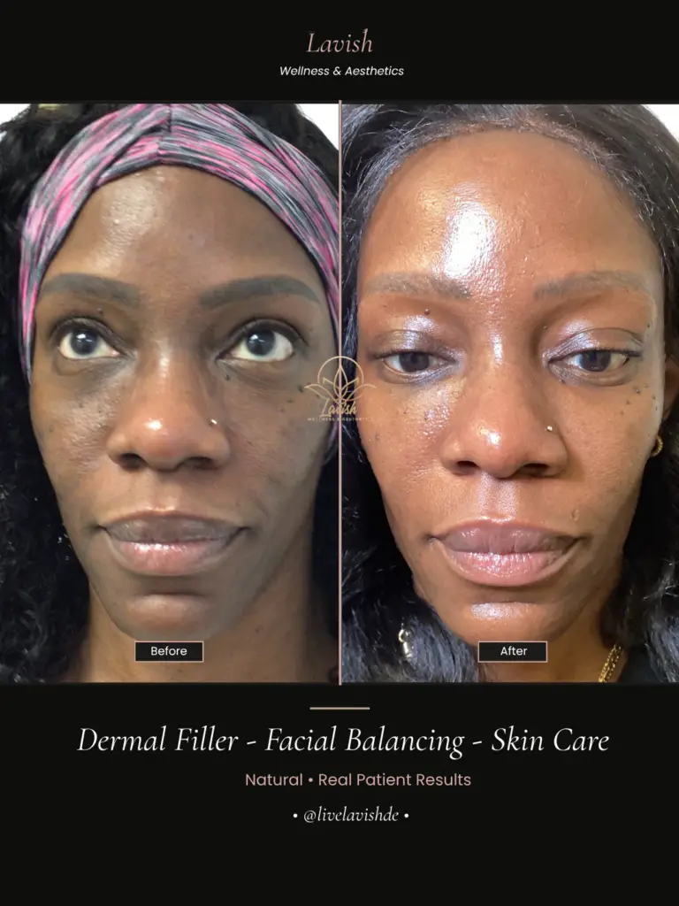 Facial Balancing In Wilmington DE (3)