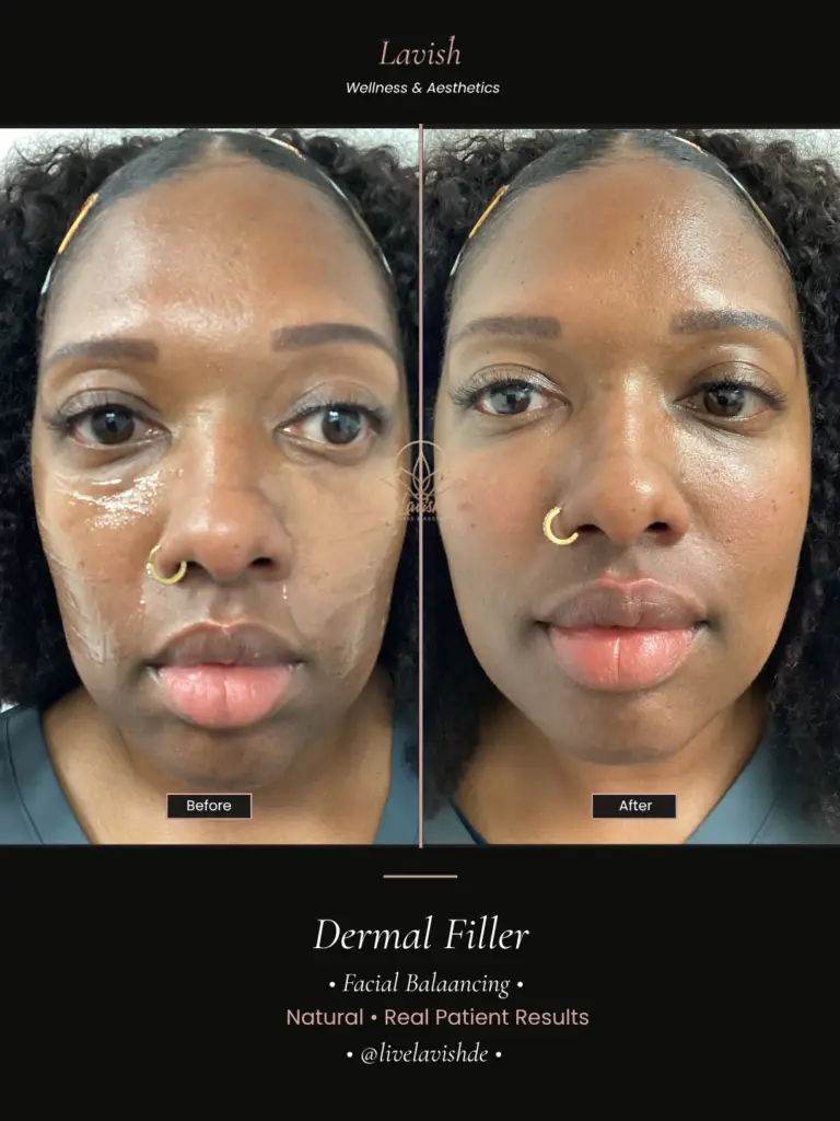 Facial Balancing In Wilmington DE (4)