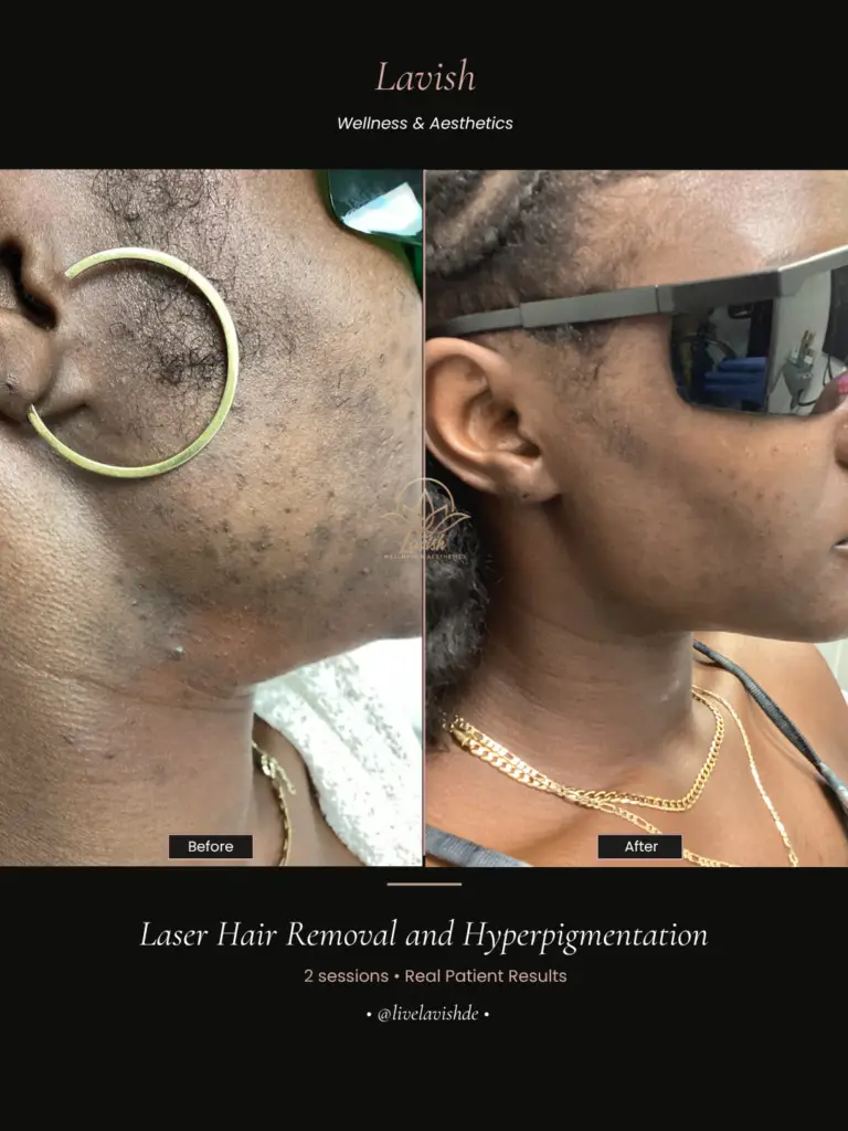 Laser Hair Removal In Wilmington DE