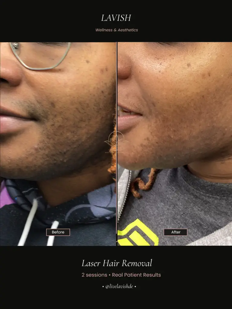 Laser Hair Removal in Wilmington