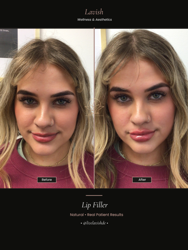 Dermal Filler In Wilmington DE