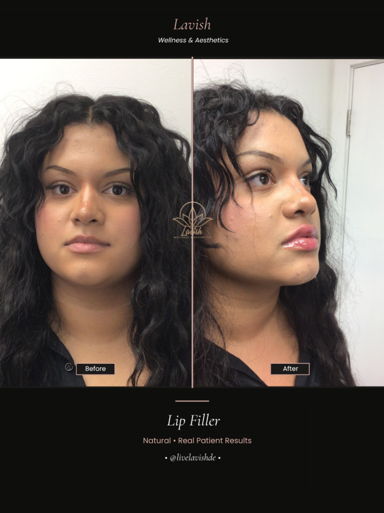 Dermal Filler In Wilmington DE