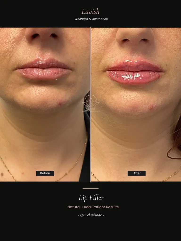 Lip Filler In Wilmington DE (3)