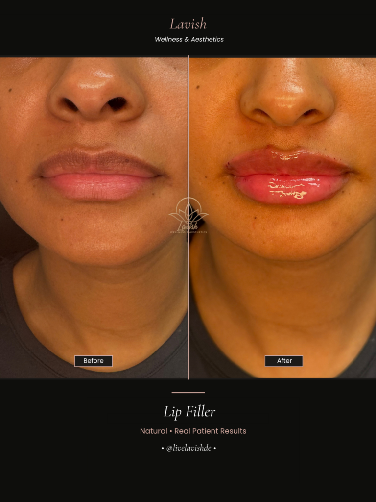 Lip Filler In Wilmington DE (4)